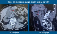 Cụ ông suýt chết vì bị xương cá xuyên thủng dạ dày