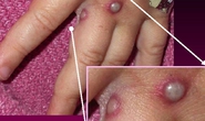 Bộ Y tế nêu 6 biện pháp phòng chống bệnh đậu mùa khỉ