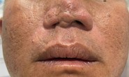 Điều trị miễn phí cho người co rút do bỏng, mất da