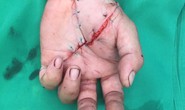 Bác sĩ xuyên đêm nối bàn tay đứt lìa cho nam bệnh nhân
