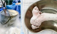 Chiến sĩ trẻ bị ung thư xương, được phẫu thuật nối xương