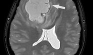 Khối u 5 cm trốn trong não nữ bệnh nhân Campuchia