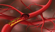 Cholesterol cao: Thêm nguyên nhân bất ngờ, không liên quan ăn uống