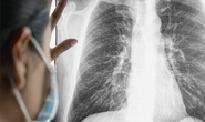 Người phụ nữ trẻ phát hiện ung thư phổi sau cơn đau ngực