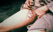 Bùng phát dịch hạch: Hơn 20 người chết
