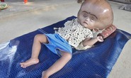 Đau lòng cô bé não úng thủy