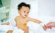 Điều trị thành công một ca dị dạng mạch máu