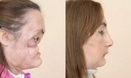 Mỹ: Bệnh nhân ghép mặt đầu tiên lộ diện