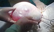Bé 14 tuổi có u nang buồng trứng nặng 4,2 kg