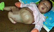 Chuyên gia Thụy Sĩ chỉnh hình chân khoèo cho bé 4 tay