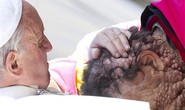 Giáo hoàng Francis ôm hôn bệnh nhân u lạ