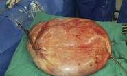 Khó thở vì khối u tử cung nặng…25kg