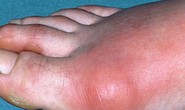 Triển vọng trị bệnh gout