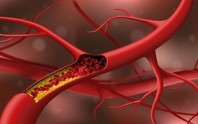 Cholesterol cao: Thêm nguyên nhân bất ngờ, không liên quan ăn uống