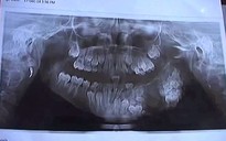Nhổ 80 chiếc răng thừa cho cậu bé 7 tuổi