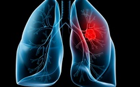 Ung thư phổi có di truyền?