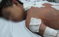 TP HCM: Nam sinh bị kẻ lạ tạt xăng đốt gần trường