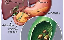 Sỏi mật làm tăng nguy cơ bệnh tim