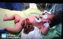 Một bé sơ sinh bị ruột nằm ngoài da hiếm gặp