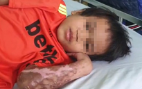 Vụ bác sĩ năn nỉ được cứu chữa cháu bé phỏng nặng: A Huyên đã bình phục, xuất viện