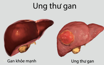 Lần đầu tiên ở ĐBSCL cứu sống bệnh nhân ung thư gan di căn