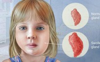 Bé gái mắc quai bị sau này có vô sinh?