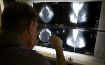 AI có thể giúp chẩn đoán ung thư vú chính xác hơn