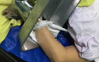 Người phụ nữ mang máy xay thịt chứa bàn tay dập nát đến bệnh viện