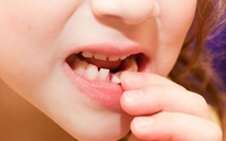 Tự nhổ răng sữa ở nhà, răng vĩnh viễn dễ lệch?