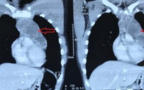 Chỉ ho nhói nhẹ, vào viện thấy u ngực to đến ngỡ ngàng