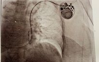 Bác sĩ vã mồ hôi với ca bệnh "tréo ngoe" có tim bên phải
