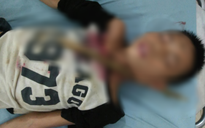 Trèo cây ngã, bé trai 12 tuổi bị cành cây đâm xuyên cổ