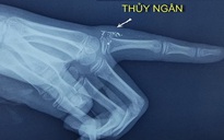 Bé gái 11 tuổi nhiễm độc thủy ngân do vỡ nhiệt kế