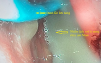 Người đàn ông suýt chết vì sỏi mật lâu ngày gây nhiễm trùng nặng