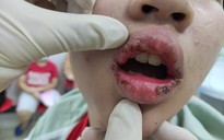Thiếu nữ 15 tuổi lở loét môi sau khi bôi son