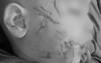 Bé trai 3 tuổi bị chó cắn tổn thương nghiêm trọng mặt và đầu