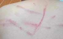 Không làm bài tập, học sinh lớp 4 ở Thanh Hóa bị cô giáo đánh lằn lưng