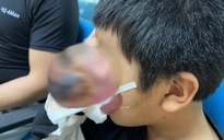 Bé trai 4 tuổi đau đớn vì khối u "quái” khổng lồ ở hốc mắt