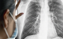Người phụ nữ trẻ phát hiện ung thư phổi sau cơn đau ngực