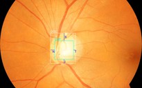 Ứng dụng AI hỗ trợ tầm soát bệnh cườm mắt