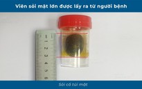 Nguy kịch vì sỏi mật "lặn" sâu