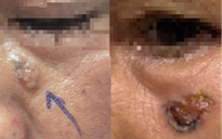 Nguy cơ ung thư da từ phong trào lưu lột da, tắm trắng