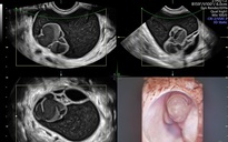 Hút cả lít dịch cứu người phụ nữ đi tiểu 15 lần mỗi đêm