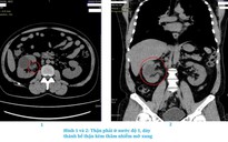 Khổ sở 7 năm vì bị lao đường tiết niệu sinh dục