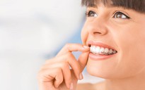 Tại sao phải đánh răng nhiều lần khi niềng răng bằng máng?