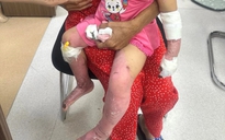 Cứu bé gái 23 tháng tuổi bị bỏng nặng và bé trai sốc sốt xuất huyết