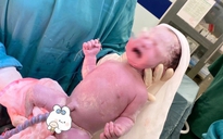 Hai em bé chào đời cùng vòng tránh thai của mẹ