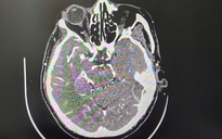 Đột quỵ khi uống bia, người đàn ông thoát chết ngoạn mục