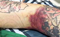 Biến chứng hiếm gặp ở nam thanh niên mắc sốt xuất huyết