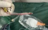 Bác sĩ cấp cứu đau lòng trước bé gái 3 tuổi sặc thức ăn ở nhà trẻ